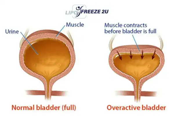 diagram of overactive bladder treatment Hemel Hempstead