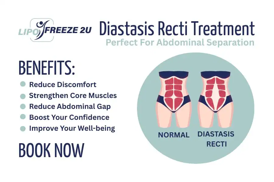 Benefits of body toning treatment Hemel Hempstead for Diastasis recti