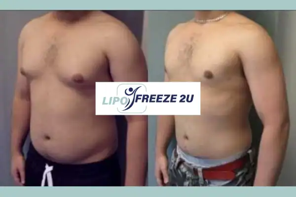 How Long Does It Take to See Results Hemel Hempstead?