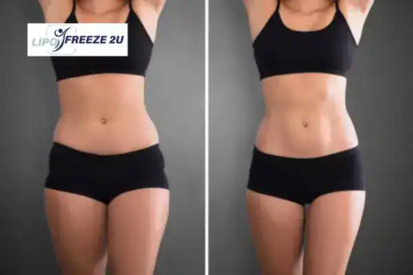 How Can LIPO FREEZE 2U Support Your Post-Pregnancy Body Recovery Hemel Hempstead?