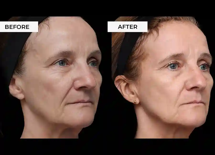 How Many RF Microneedling Sessions Will You Need to See a Difference Hemel Hempstead?