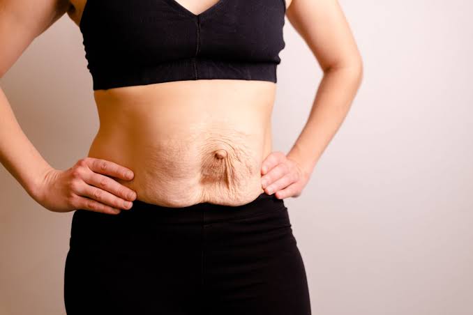 Is Surgery Really the Only Way to Repair Diastasis Recti Hemel Hempstead?