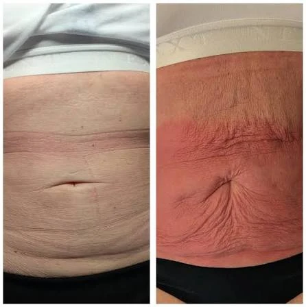 How Does RF Microneedling Improve Crepey, Thin and Uneven Skin Texture Hemel Hempstead?