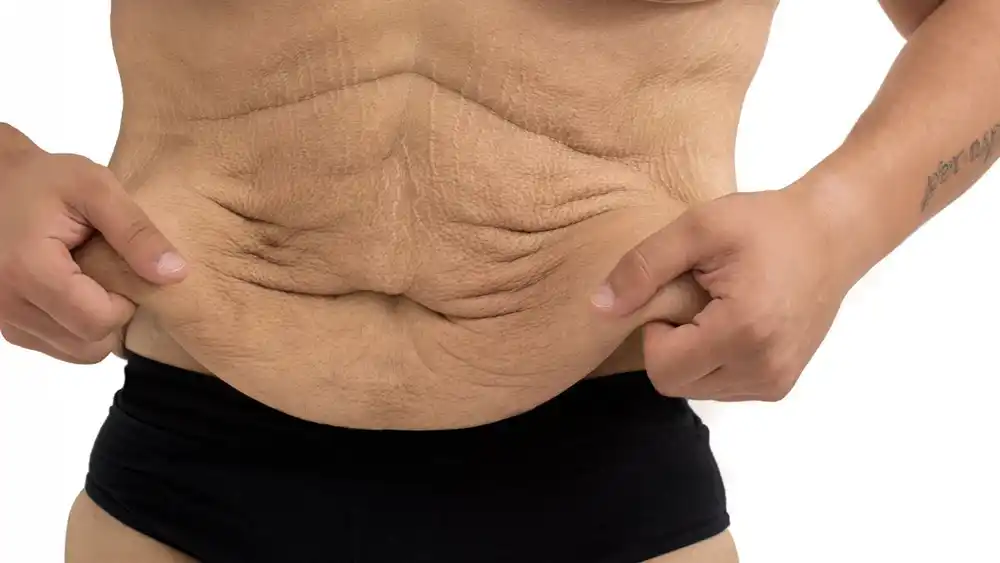 Why Does Weight Loss Medication Leave Some People With Loose or Sagging Skin Hemel Hempstead?